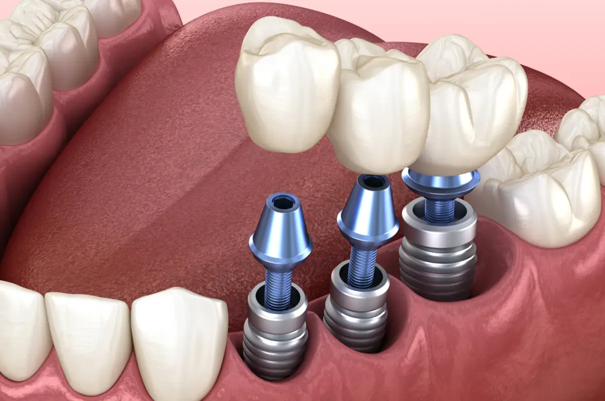 Impianti dentali - Olbia Dental Studio Impianti dentali - Olbia Dental Studio