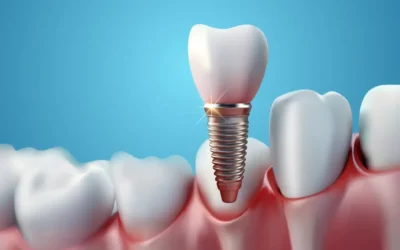 Impianti dentali a Olbia: cosa sono, quando servono e come funzionano