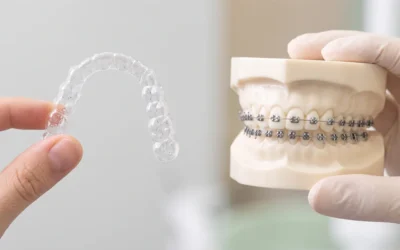 Allineatori trasparenti vs apparecchio fisso: quale scegliere da adulti