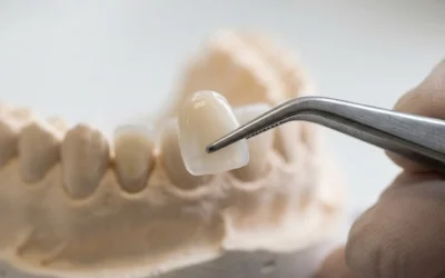 Quanto costano le faccette dentali? Guida ai prezzi e alle variabili